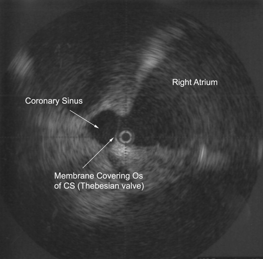 Difficult Access of Coronary Sinus During Attempted Percutaneous LV Lead Insertion – Heart ...
