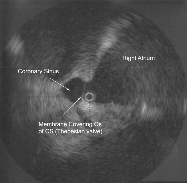 Difficult Access of Coronary Sinus During Attempted Percutaneous LV Lead Insertion – Heart ...
