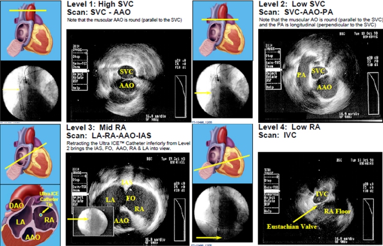 Figure 1  Basic Cardiac Anatomy with Radial Intracardiac Echocardiography (ICE).  