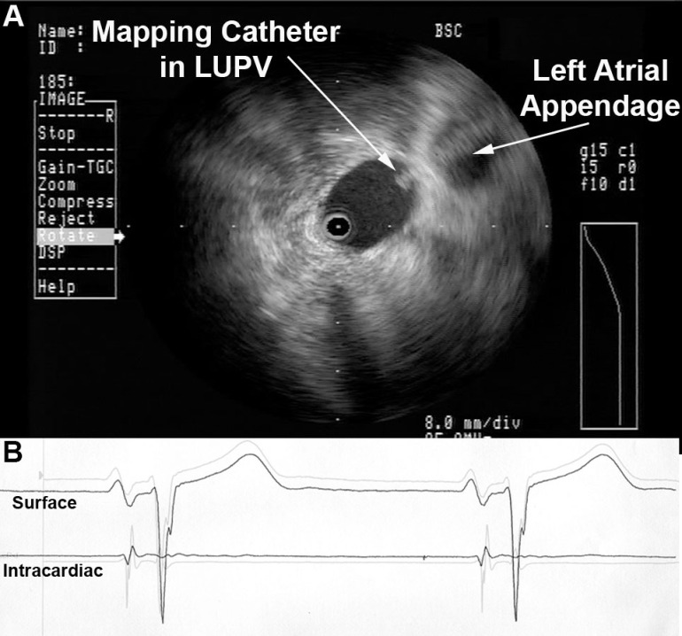 Left Atrial Appendage Electrogram Mimicking Left Upper PV Potential