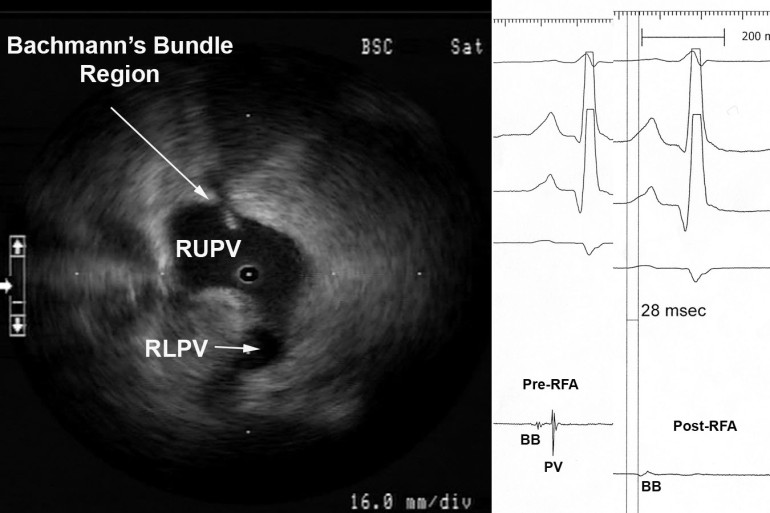 Myocardial Potential in the Right Upper Pulmonary Vein that may Represent Bachmann’s Bundle Potential