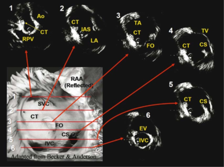Figure 4  Radial ICE Assessment of RA Anatomy. Figure from Springer, Journal of Interventional Cardiac Electrophysiology
