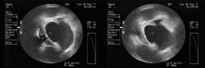 Intracardiac Echocardiography (ICE) of Orogastric Tube (OGT). The left image depicts the ICE signature of the OGT at ~8 o’clock. There is a small indentation in the posterior left atrial wall at the site of the OGT. On the right, ICE demonstrates the resolution of this indentation after removal of the OGT. 